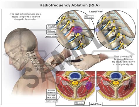 Because RFA thyroid nodule treatment is relatively new, risk for these procedures is still being evaluated. . Radiofrequency ablation car accident settlement georgia